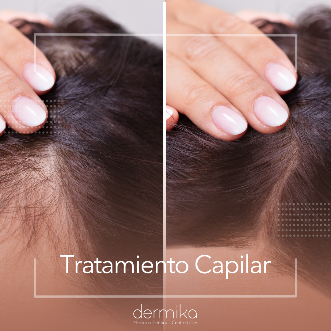 Tratamiento Capilar